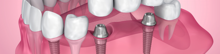 dental implants vs dental bridges