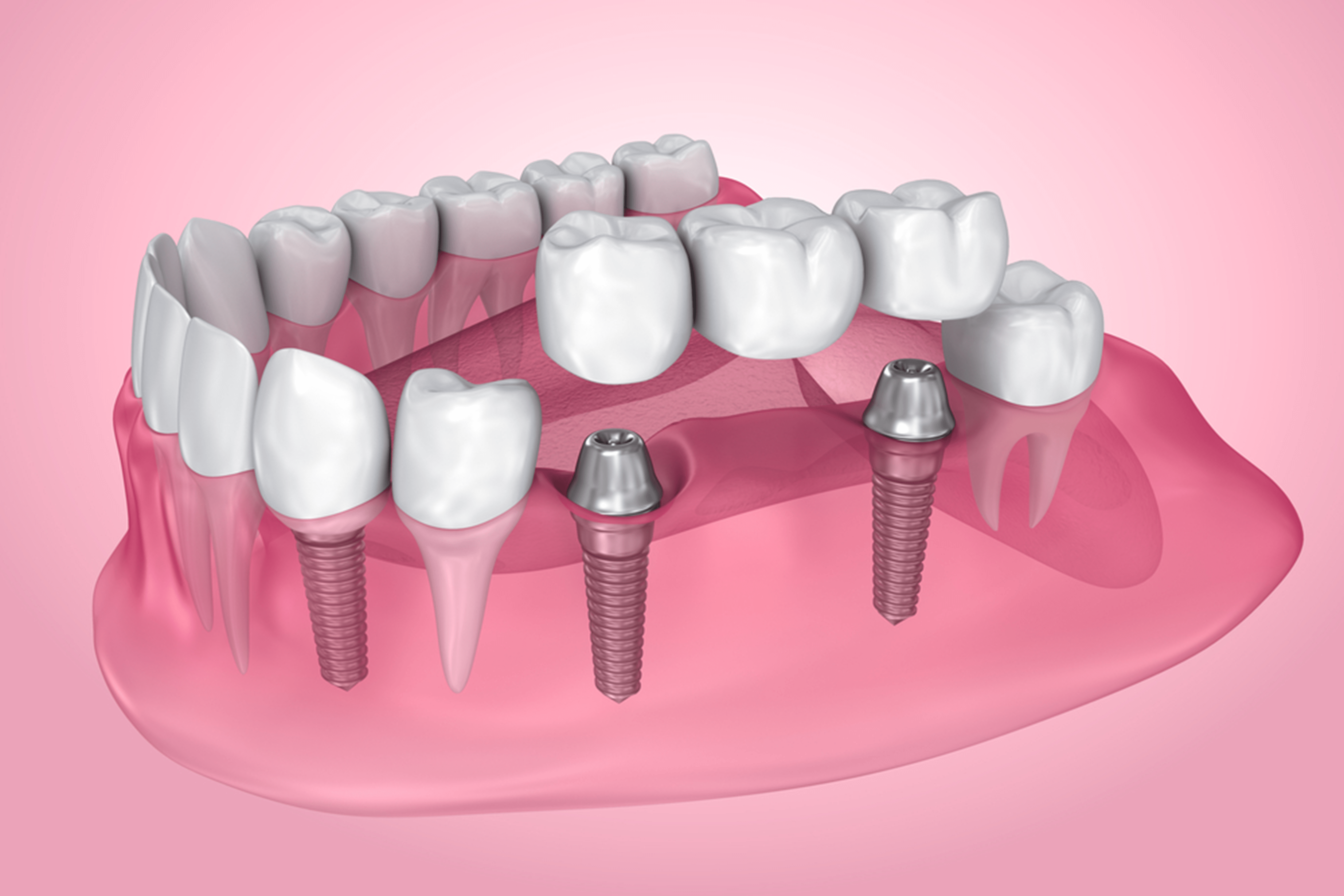 dental-implants-vs-dental-bridges