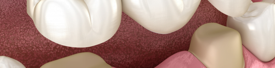 everything that you need to know about dental bridging