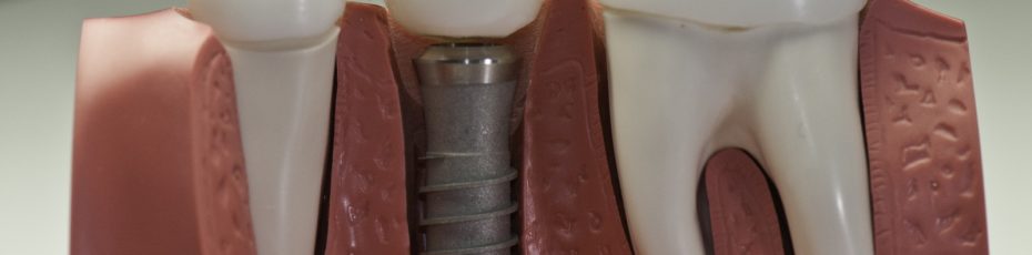 you are ready for dental implants if