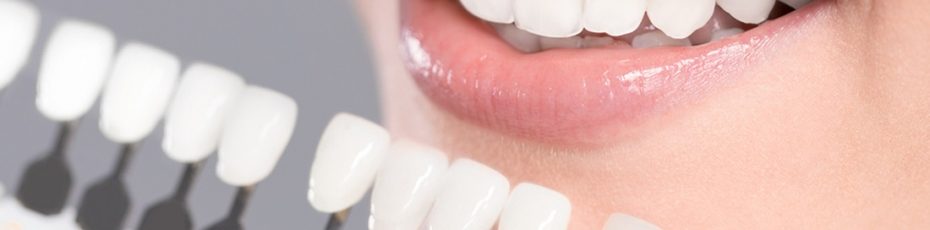 what are dental veneers and how do they work