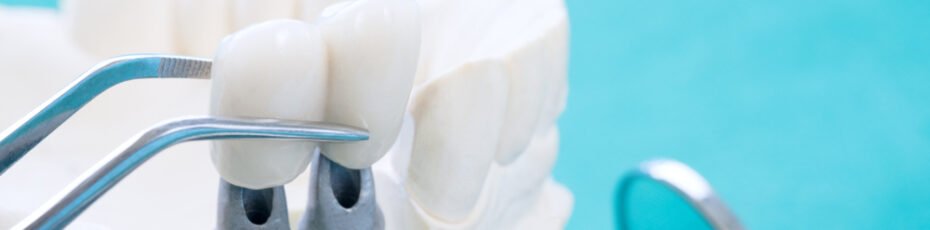 dental bridge aftercare tips for a smooth recovery