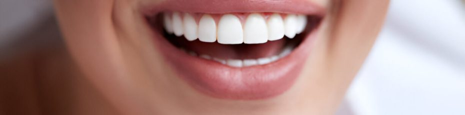 Dental Veneers in St. Albert, AB