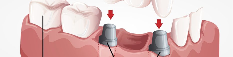 Dental Crowns in St. Albert, AB
