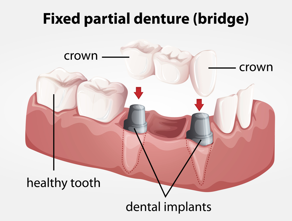 Dental Crowns in St. Albert, AB
