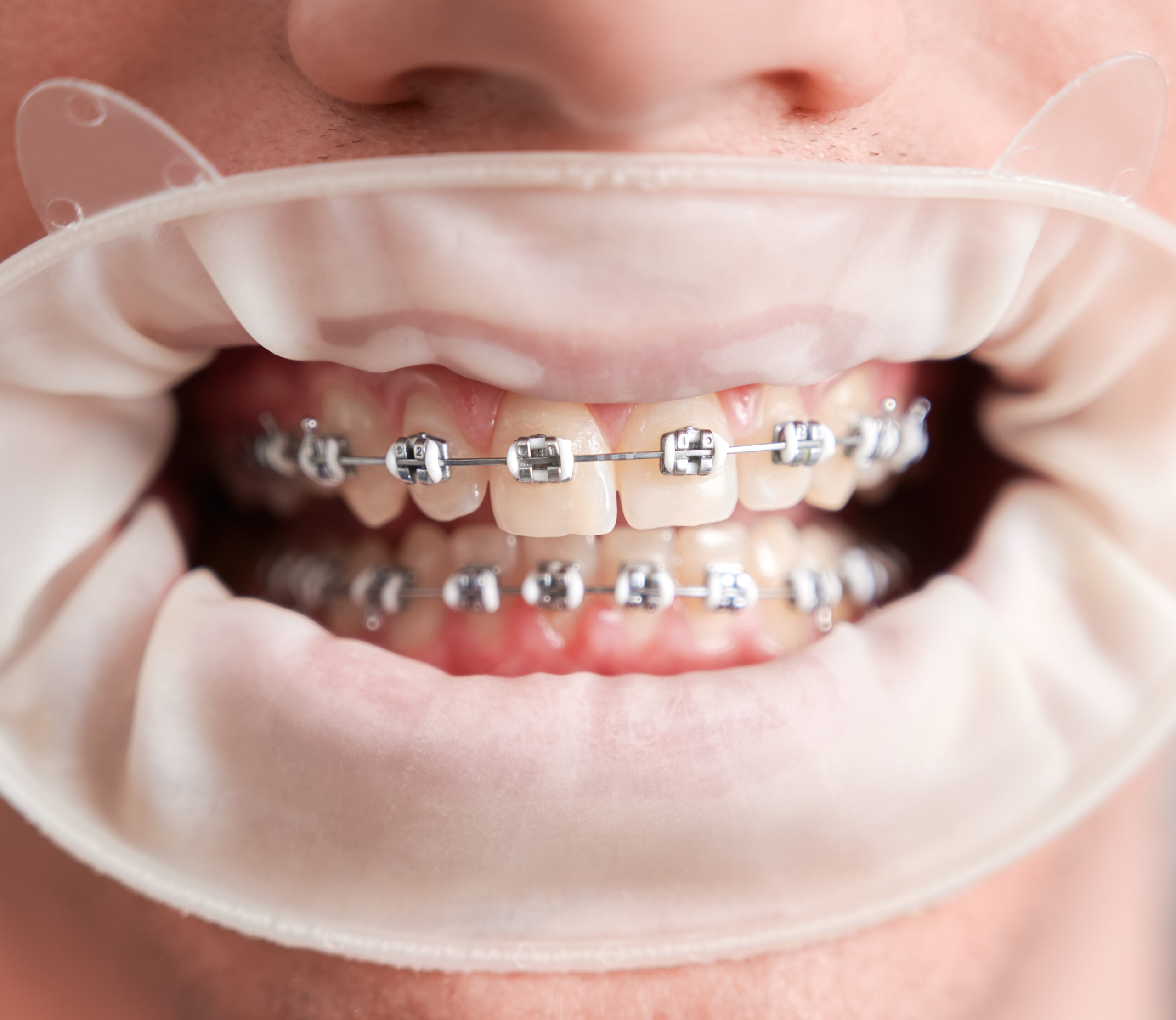 Braces near you in St. Albert