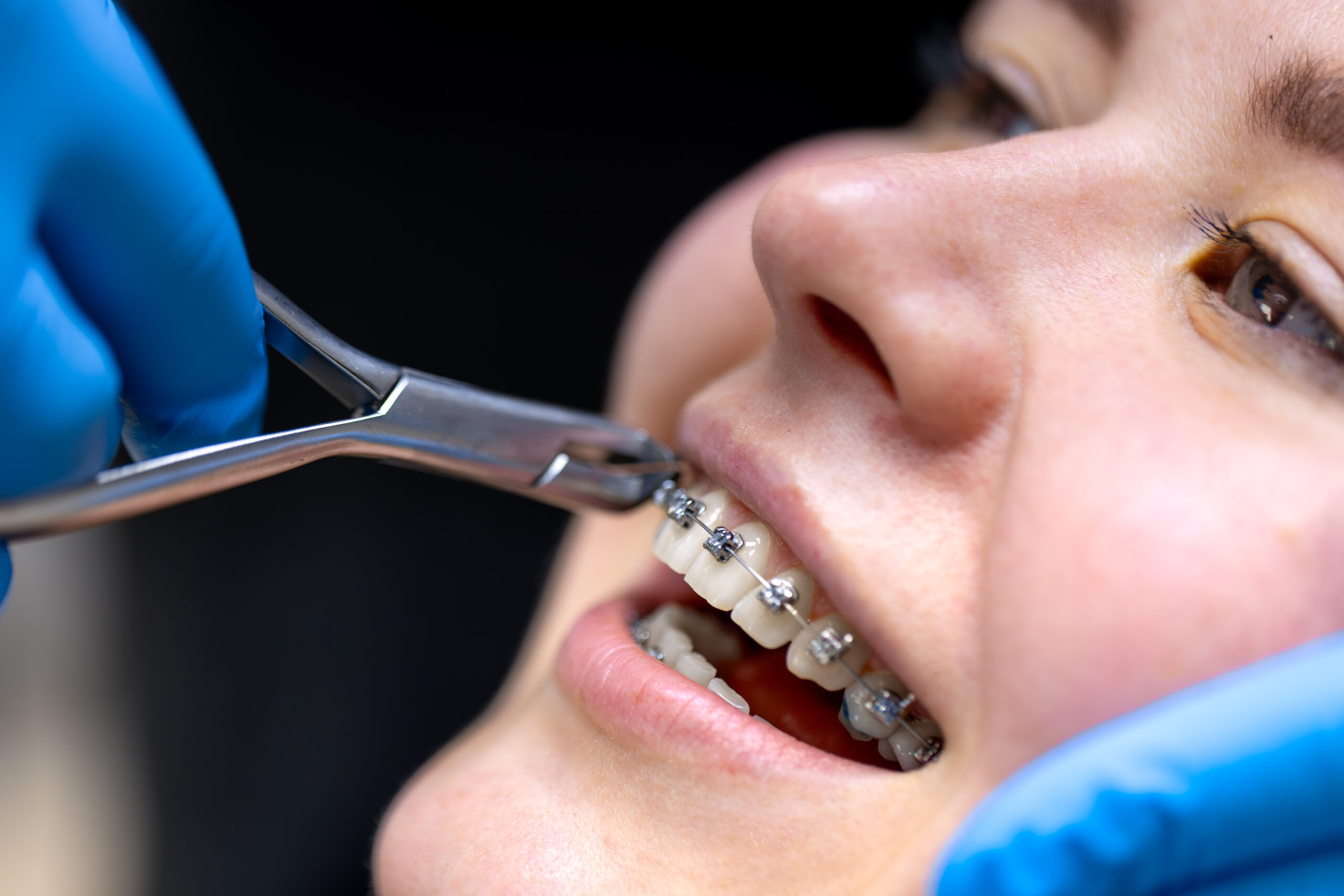 Braces in St. Albert