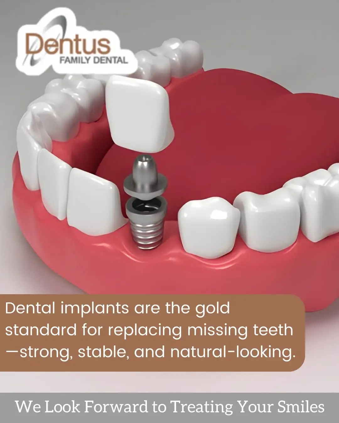 dental implants