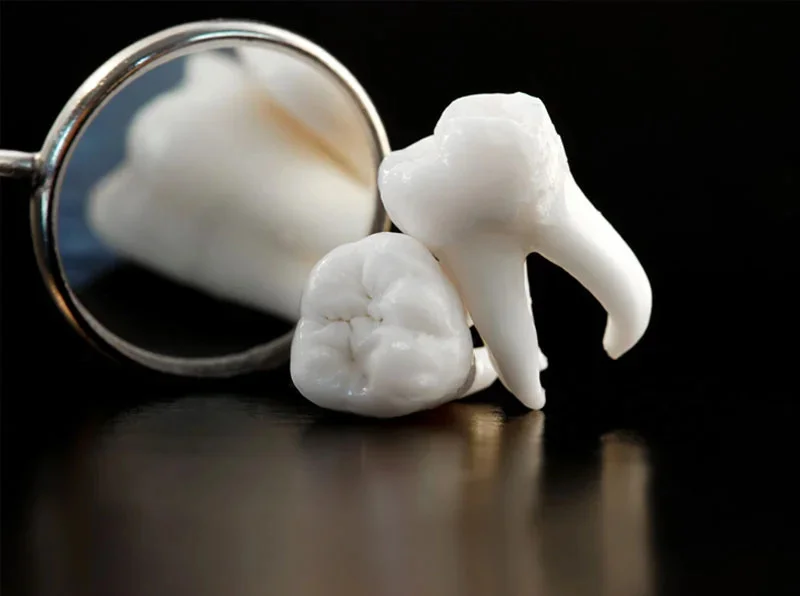 Surgical Teeth Extraction in St. Albert
